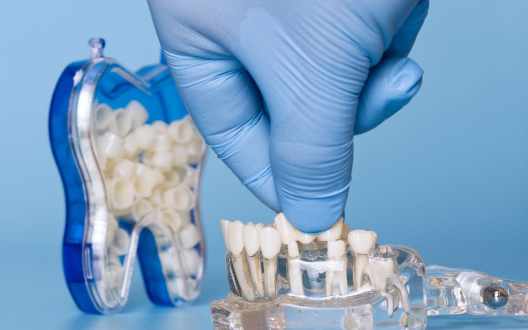 5 Powerful Reasons to Choose Dental Crowns & Bridges 