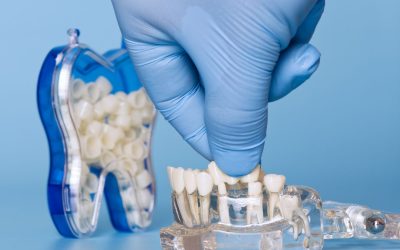 5 Powerful Reasons to Choose Dental Crowns & Bridges 