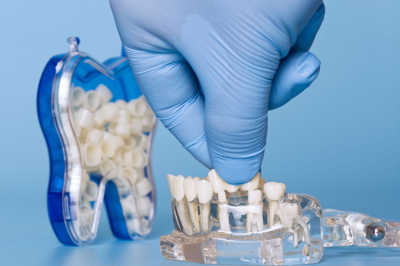 Dental Crowns & Bridges