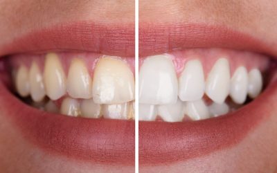 Say Goodbye to Stains with Professional Teeth Whitening 